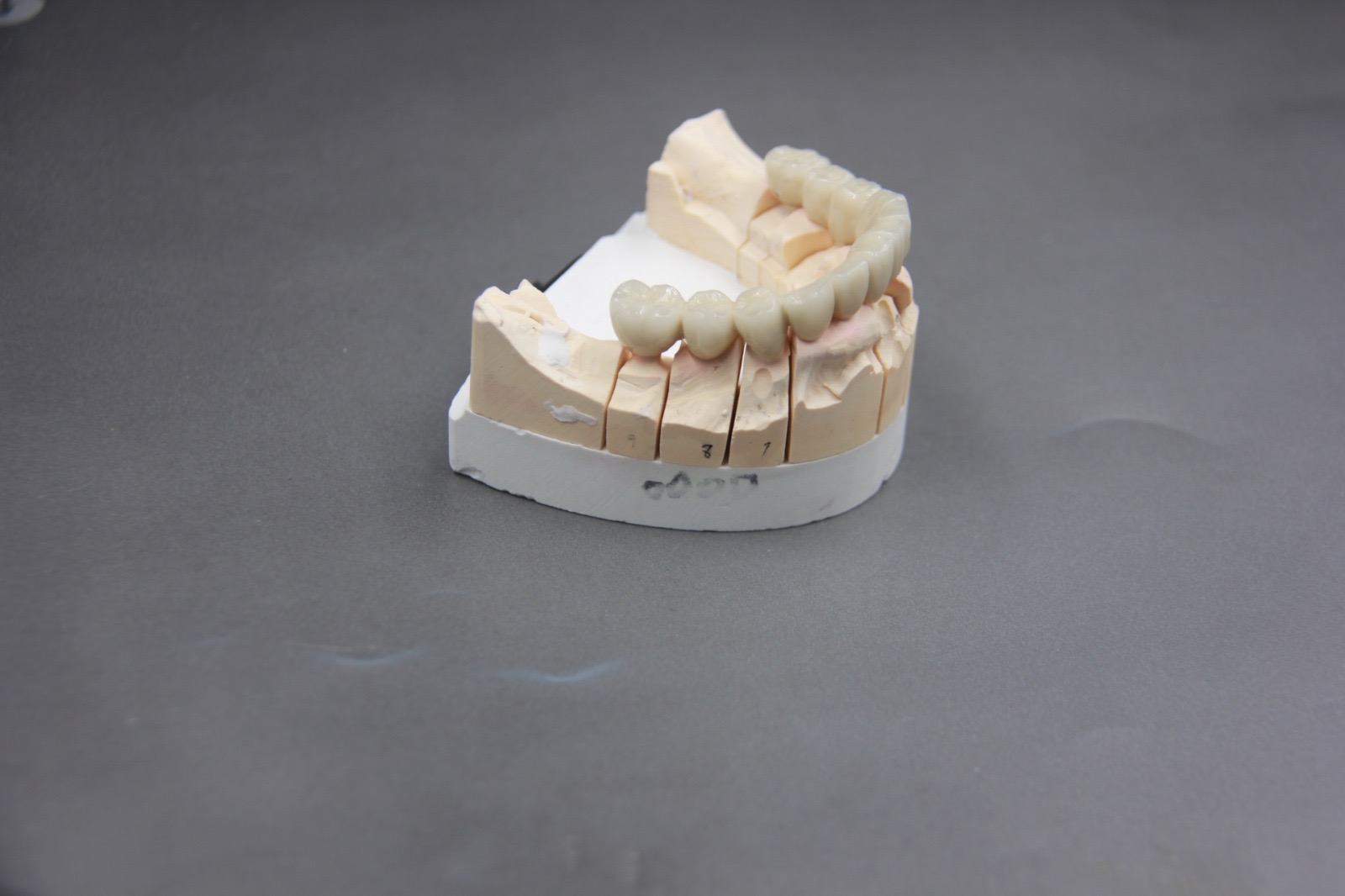 Posterior bridge fitted on a working cast