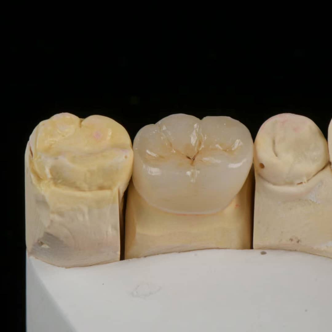 Molar crown on a working model showing natural anatomy and fit